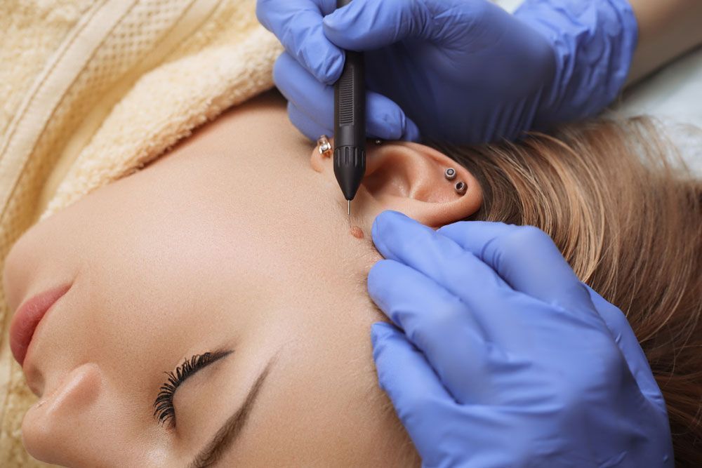 ELECTRO CAUTERIZATION
