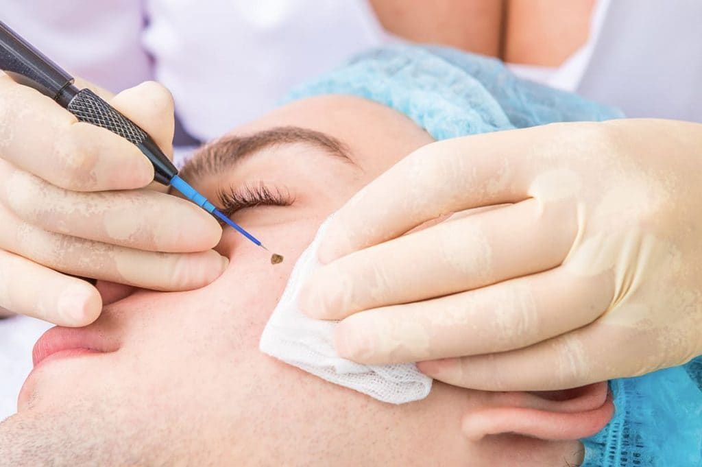 MOLE AND WART CAUTERIZATION