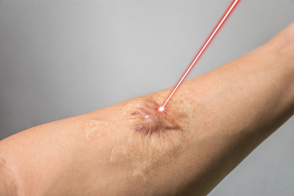 BURN SCAR TREATMENT WITH LASER